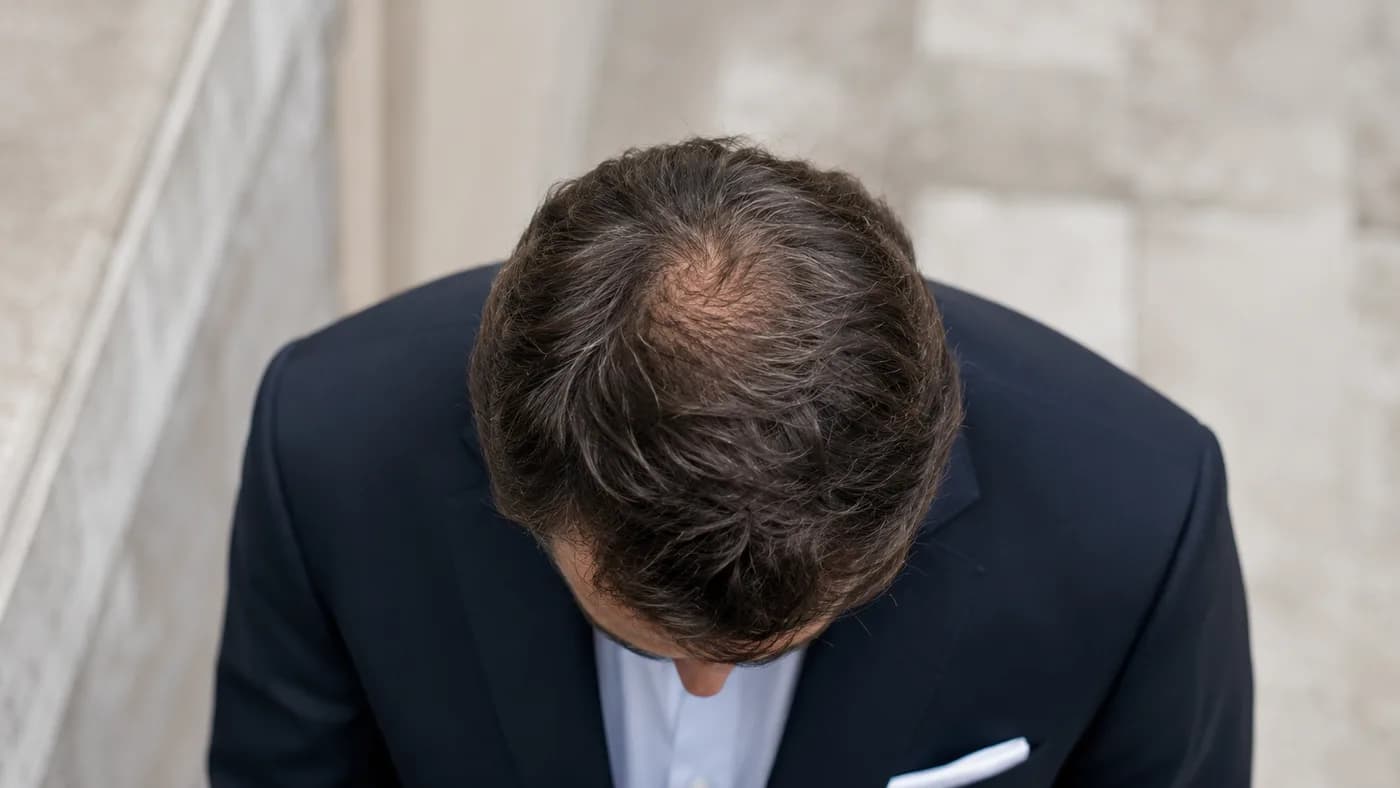 Man with a small visible bald spot at the crown in natural daylight